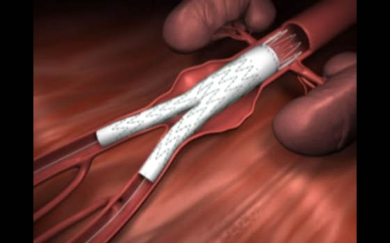 Reparo endovascular de aorta